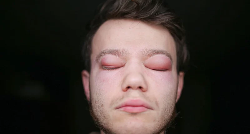Angioedema