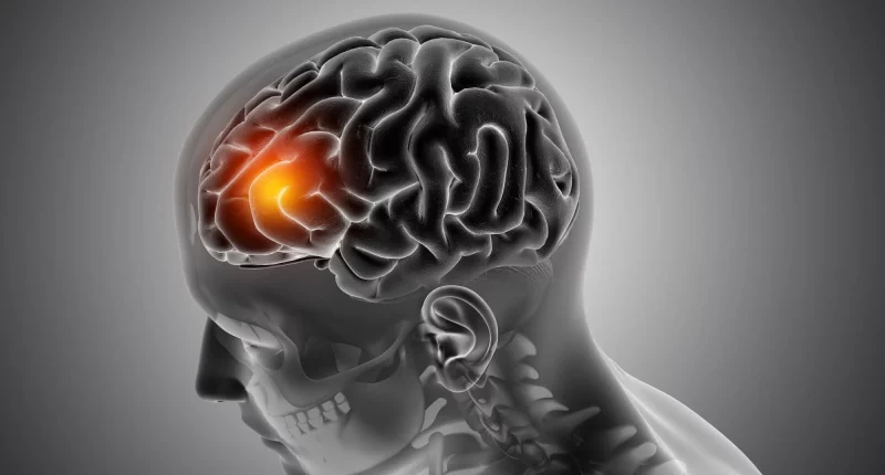 Basal Ganglia Stroke