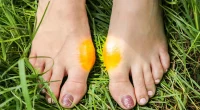 Bunion